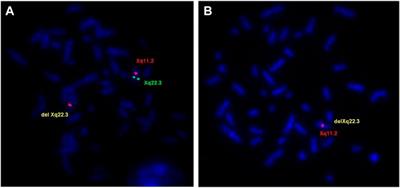 Case Report: Contiguous Xq22.3 Deletion Associated with ATS-ID Syndrome: From Genotype to Further Delineation of the Phenotype